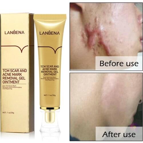 LANBENA Original Herbal Acne Scar Removal Gel Spots Treatment Stretch Marks Removal Pigmentation Corrector Whiting Cream 30g