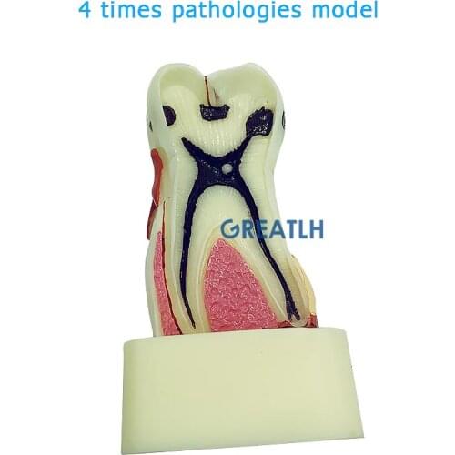 Teeth Model Dentist Dental Educational Equipment 4 Times Pathologies Model Dental Model Disease