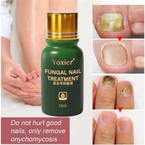 Fungal Nail Treatment Antibacterial Serum Repair Rough Discolored Anti Infection Paronychia Onychomycosis Foot Care