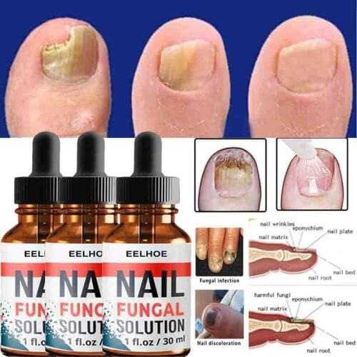Nail Repair Serum Nail Fungal Treatment Serum Onychomycosis Paronychia Anti-Fungal Nail Infection Toe Fungus Foot Repair Care