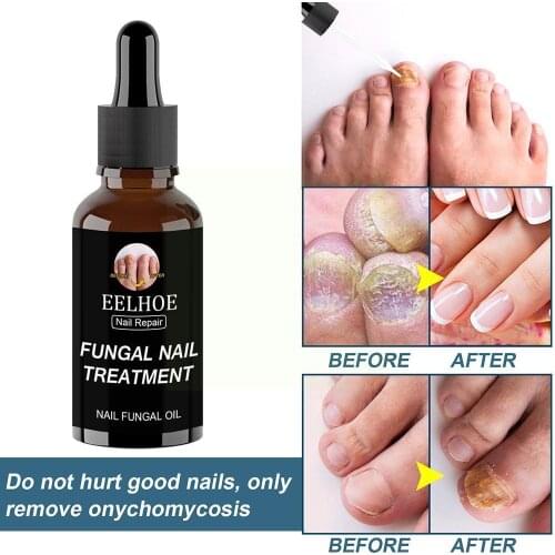 Fungus Repair Essence Onychomycosis Psoriasis Infection Infection Tool Prevent Natural Fungal Treatment Paronychia Care Car O1W1