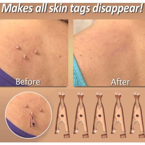 10PC Small Clip Copper Tag Out remover skin care Mole Wart Remover Micro Band Skin Tag Removal Kit With Cleansing face beauty