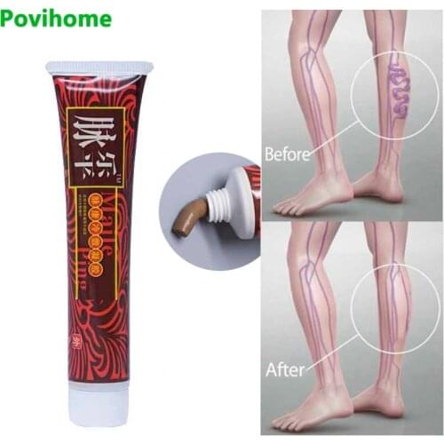 1Pcs Varicose Veins Ointment Treatment Varicosity Angiitis Removal Medical Plaster Relief Vasculitis Phlebitis Spider Cream