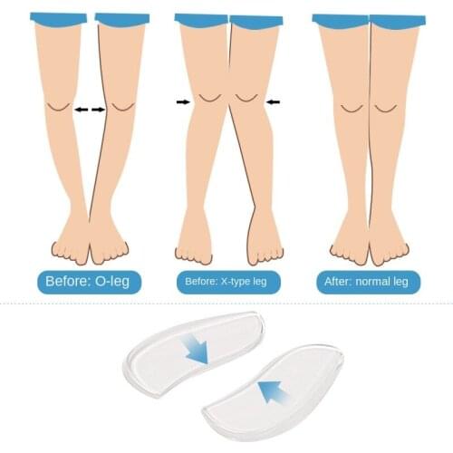 2 Pcs Silicone Insoles Orthotics X/O-type Legs Corrector Gel Pillow For Heel Orthopedic Insoles Shoes Pad For Feet Care Solid