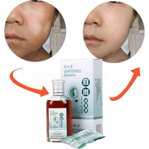 50ml Skin Treatment White Spot Disease Remover Liquid Pigment Melanin Promoting Liniment Skin Vitiligo Leukoplakia Treatment