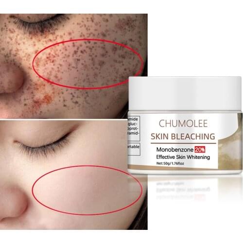 Dimollaure Effetive Face Whitening Cream Monobenzone 20% Skin Bleaching Fades Vitilig Dark Spots Age Spot Brightening Face Cream