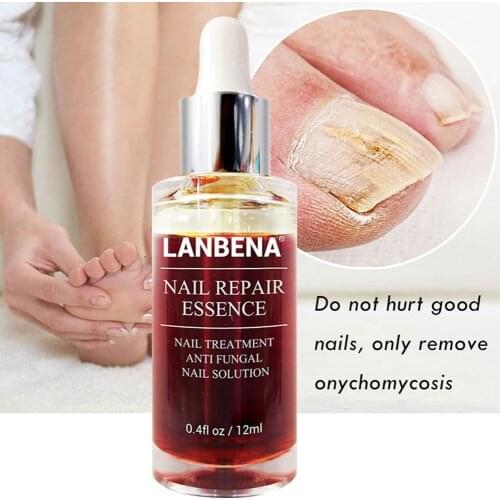 Serum Healthy Portable Fungus Foot Nail Removal Repair Essence Treatment