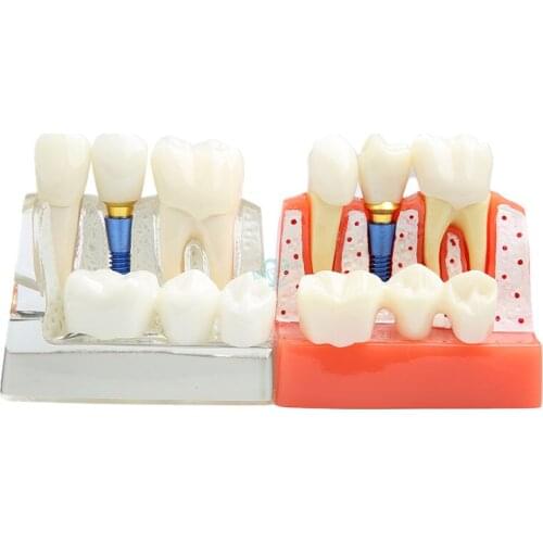 1pcs Dental Demonstration Teeth Model Dental Teach Implant Analysis Crown Bridge Removable Model
