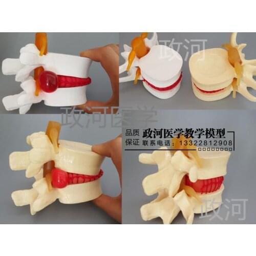 Medical human lumbar disc protrusion demonstration model lumbar intervertebral disc herniation spine model