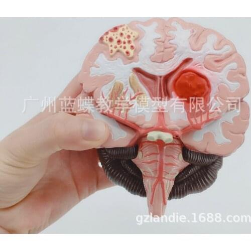 1:1 Humans Brain Disease Model Brain Anatomical Model Neurosurgery Cerebral Hemorrhage Pathological Medical Teaching Model
