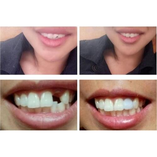 50% Hot Sale 3/10/20ml DIY Temporary Tooth Filling Material Missing Teeth Repair Dental Tool
