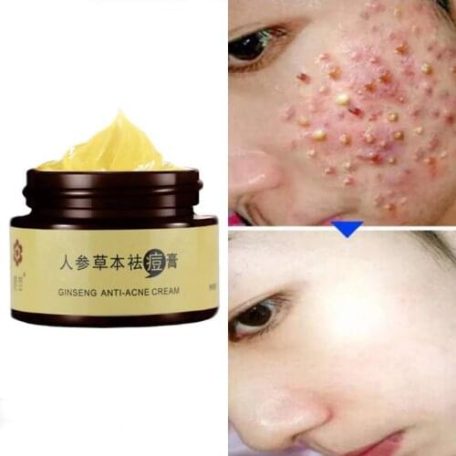 35g Ginseng Aloe Acne Cream Chinese Herb Acne Treatment Cream Anti Pimples Spot Acne Scars Blackhead Removal Whitening Cream