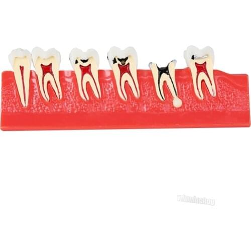 1Pcs Dental caries model Illustration Model 4011 For Medical Teaching Model