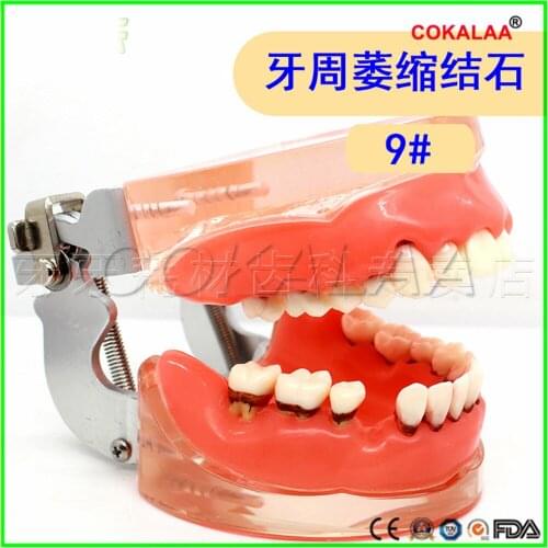Good quality Tartar model Doctor-patient communication dental implant model dentures teeth model for dentists learning