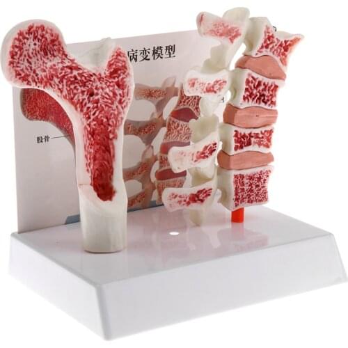 1:1 Anatomical Human Lumbar Vertebra Thighbone Model, Osteoporosis Skeleton Model, for Science Classroom Study Display