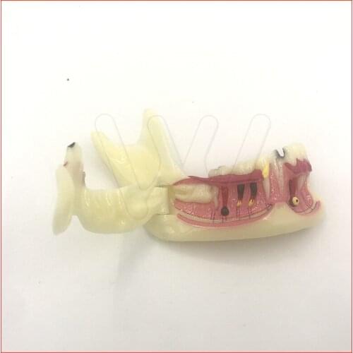 Orthodontic Braces Dental Mandibular Tissue Teeth Demonstration Anatomical Model Patient Study Teach Model