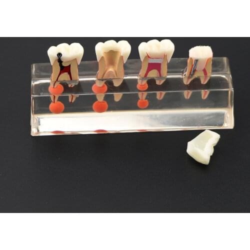 Dental Endodontic Treatment Teeth Model Demonstrate 01 - 4-Stage molar Root canal treatment Teeth Model M4018