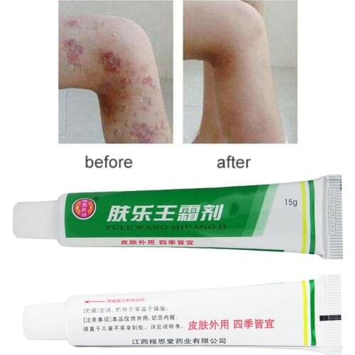 1PC Herbal Material Psoriasis treatment Creams Dermatitis Eczema Pruritus Psoriasis Ointment Body Cream 15g