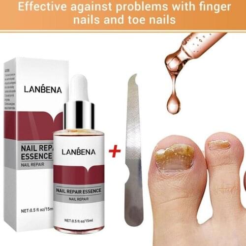 Liquid Anti Fungus Nail Repair Essence Serum Fungal Treatment Remove Nail Onychomycosis Nourishing Brighten Hand Foot Skin Care