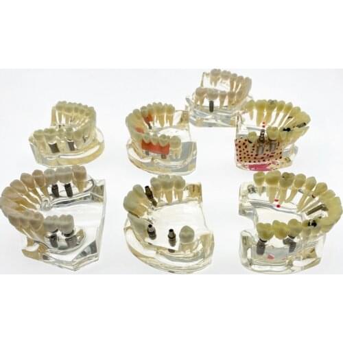Dental Teeth model Implant With Bridge & Caries Dental Study Teach Model