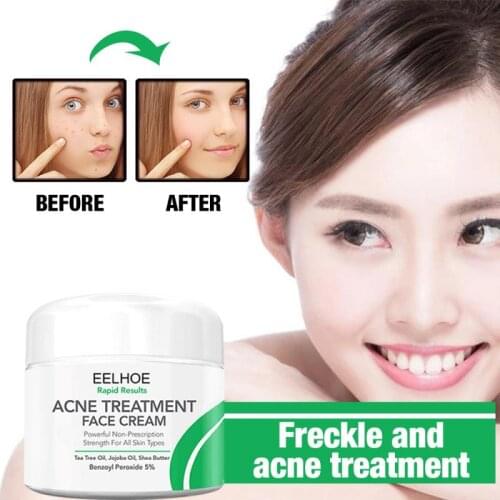 50g Anti Acne Treatment Creams Freckle Scar Blackhead Remove Whitening Moisturizing Face Cream Anti-aging Firmly Skin Cream