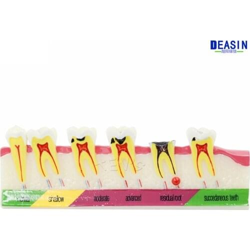 High Quality Dental Caries Developing illusteation Tooth Model Demonstration Teach Patient