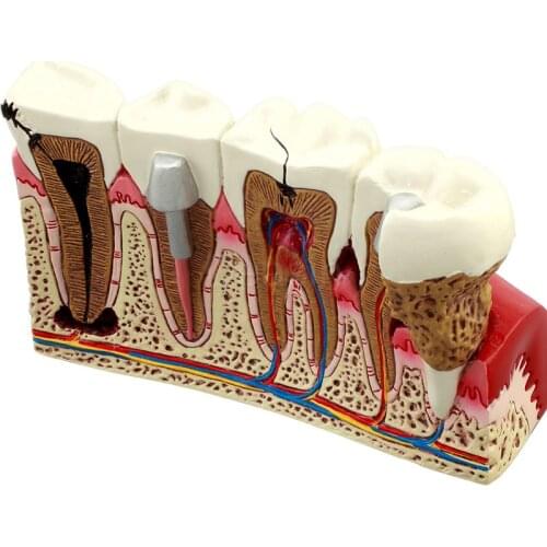 Dental Anatomy of dental caries plastic teeth model demonstration communication