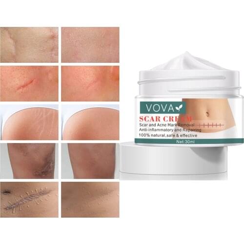 30ml Acne Scar Removal Cream Pimples Stretch Marks Face Gel Remove Acne Smoothing Whitening Moisturizing Body Cream Skin Care