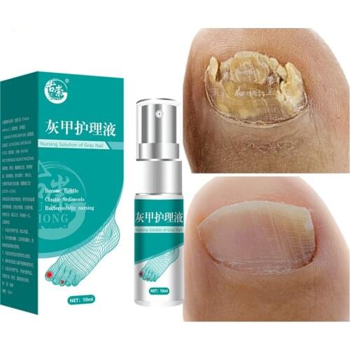 Nail Fungal Treatment Feet Care Essence Nail Foot Whitening Toe Nail Fungus Removal Gel Anti Infection Paronychia Onychomycosis