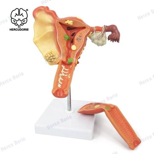 Uterine Pathological Model Reproductive Model, Medical Anatomical Human Ovarian Vaginal Disease for Teaching, Cross Sectionclass