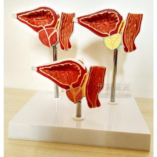 Prostate pathology teaching model Prostate lesions anatomy education teaching model