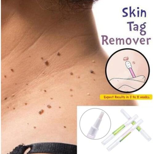 Genital Wart Treatment Papillomas Removal Of Warts Liquid From Skin Tags Remover Against Mole Remover Wart Removal Liuld TSLM2