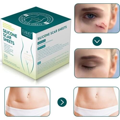 ELAIMEI 300cm Silicone Gel Strips Patch Scar Removal Patch Remove Trauma Burn Scar Sheet Skin Repair Therapy Patch