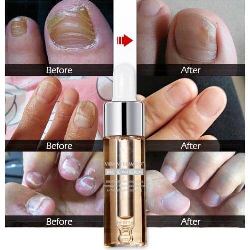 15g Onychomycosis Armor Serum toe nail fungus treatment nail growth toe nails fungal Essence