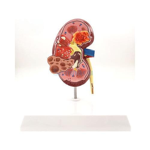 Diseased Kidney Model Human Anatomical Medical Pathological Changes Specimen for Patient Education