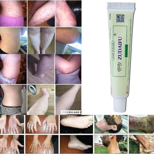 10pcs zudaifu body cream without retail box men women skin care product relieve Psoriasis Dermatitis Eczema Pruritus effect
