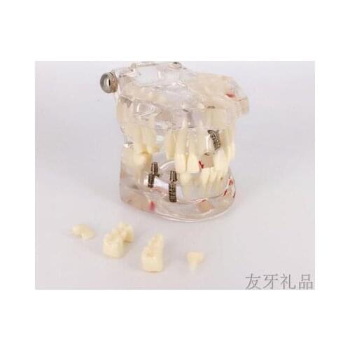 Oral cavity model Dental teaching Adult transparent pathological planting repair model demonstration models free shipping