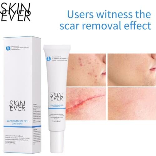 SKIN EVER Acne Scar Removal Cream Gel Face Pimples Stretch Marks Cream Repairing Smoothing Whitening Moisturizing Skin Care 30g