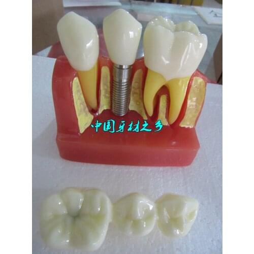 Dentistry material oral Four times Planting model Three teeth Planting nail red tooth model free shipping