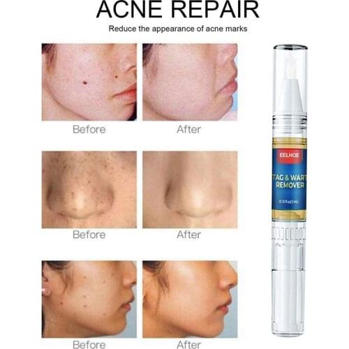 3Ml New 1PC Wart Treatment Liquid Pen Transparent Face Spot Wart Skin Removal Tag Care Remover Dark Freckle Y3N8