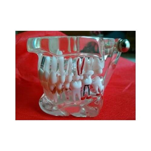Dental Materials Dental model tooth pathology Removable free shipping