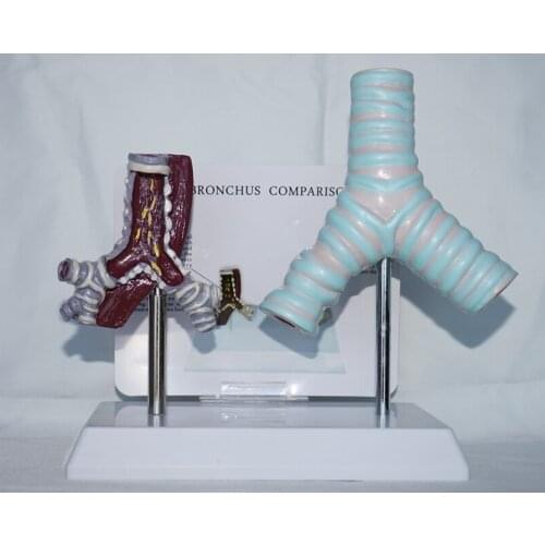 Smoking Trachea and normal trachea comparison model Human body model Medical teaching