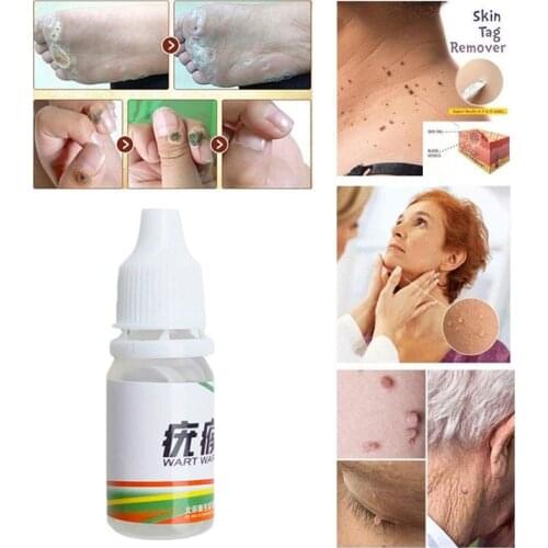 Skin Tag Remover Medical Tu Kill Remove Skin Tag Mole & Genital Wart Remover