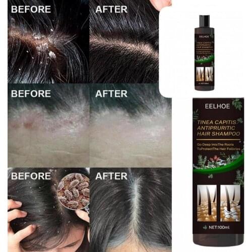 Anti-dandruff Shampoo Nourishing Effective Improve Hair Quality Hair Dandruff Removal Shampoo