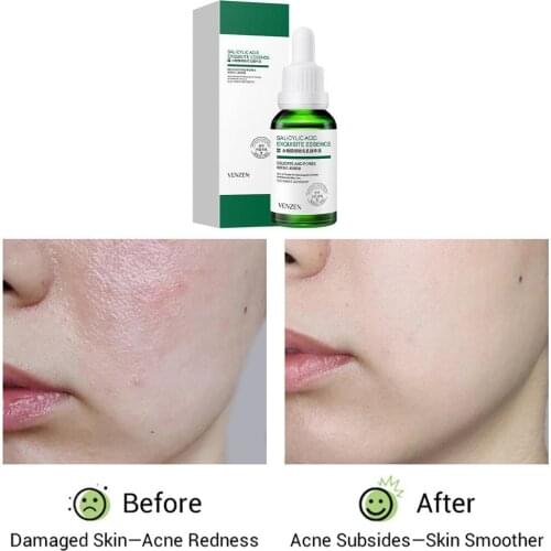 Salicylic Acid Face Serum Hyaluronic Acid Shrink Pores Essence Liquid Moisturizing Oil Control Anti-Wrinkle Lighten Skin Care