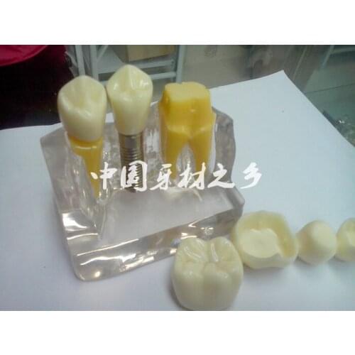 Dental materials Planting nail Break up demonstration oral Four times Planting model transparent tooth free shipping