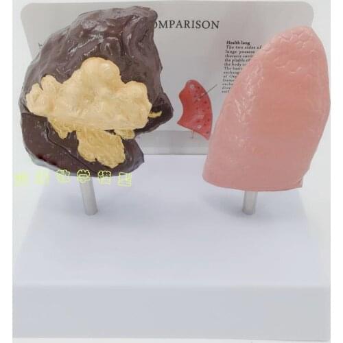 Lung structure mold Smoking harms health Smoking lung respiratory system Pathological lung anatomical model