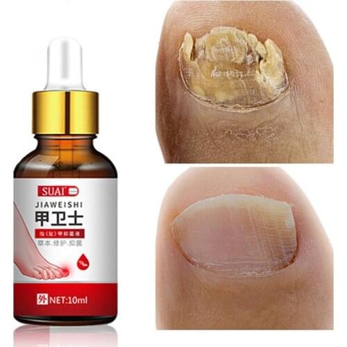 Nail Fungal Treatment Serum Feet Care Essence Nail Foot Fungus Removal Gel Toenails Anti Infection Paronychia Onychomycosis