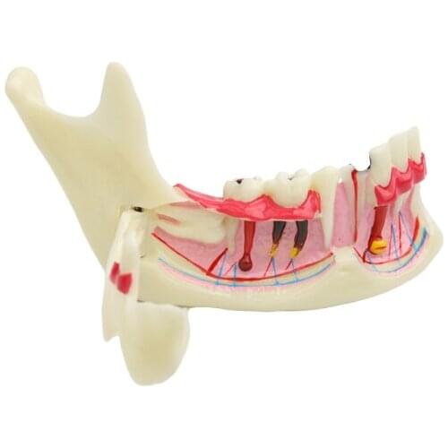1pcs Dental Teaching Model Mandibular Teeth Demonstration Anatomical Patient