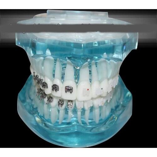 Dental Orthodontic model self-ligating bracket straight wire edgewise bracket four kinds of ceramic brackets comparison model